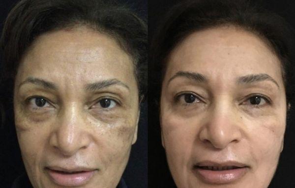 After 3 treatments of Chemical peel