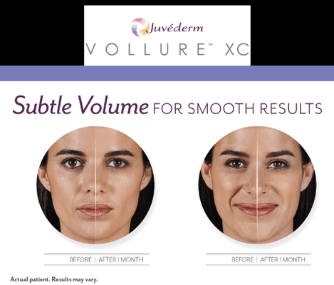 Vollure by Juvederm lasts up to 18 months!