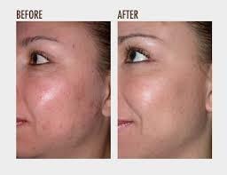 Before & After IPL Photofacials