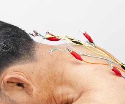 Electroacupuncture