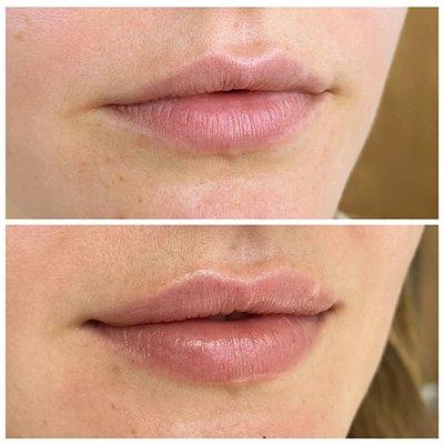 Before/After Juvederm