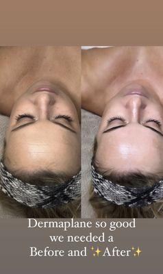 Dermaplane Before and After