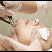 Microdermabrasion