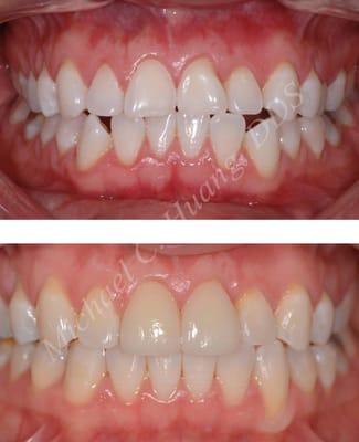 Invisalign + all-porcelain crowns