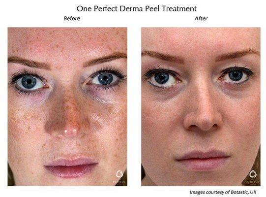 Perfect Derma Peels before and afters