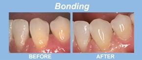 Cosmetic bonding is a simple way to correct isolated defects, chips and wear; even fill gaps or spaces...