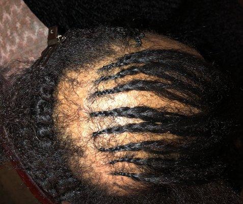 Part2 Alopecia braided weave style