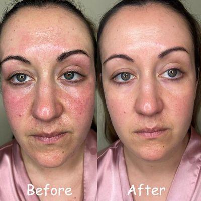 Rosacea cleared after facial treatments