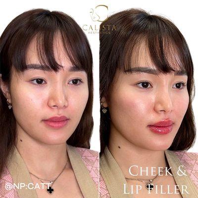 Lip and cheek filler by NP Cat