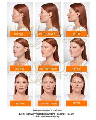 Kybella for stubborn double chin, call for consultation to see if you are a candidate.