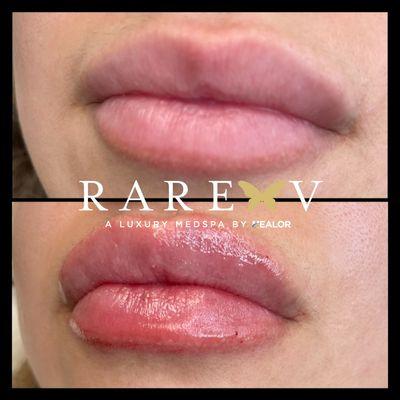 RAREV Medspa Lip Injections