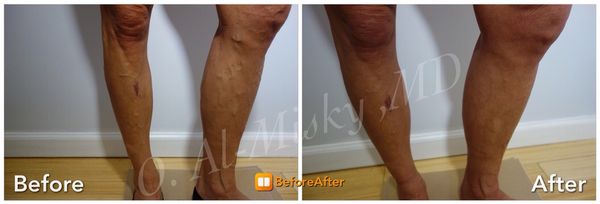 Before/After : Varicose veins treated with Sclerotherapy.