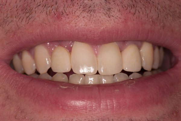 Congenitally missing lateral incisors replaced with implant crowns.