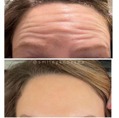 Botox can literally reverse almost ANY wrinkles and/or fine lines and prevent them from happening again or even getting started!