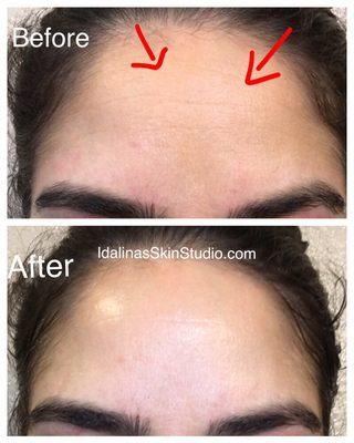 An example of an individually designed treatment of a peel & LED treatment with proper home care to target fine lines & wrinkles