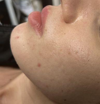 Before C02 Fractional Skin Resurfacing for Acne Scars