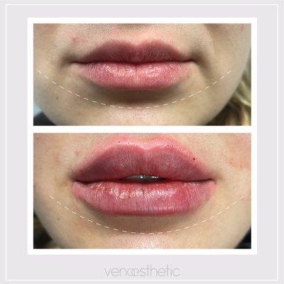 Lip augmentation and definition