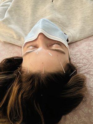 Acupuncture help with Migraine headaches