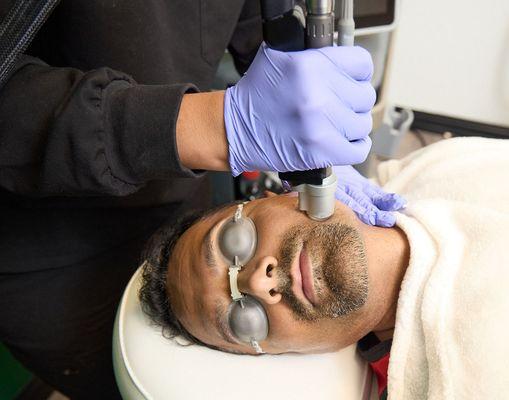 Facial Laser Hair Removal on Men