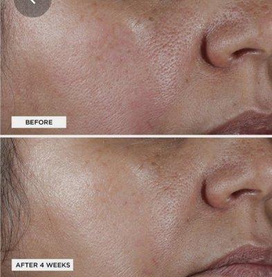 Before & after Dermaplane Facial