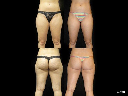 29 YEAR OLD WOMAN, 162 LBS, 5'9″, LIPOSUCTION, ORANGE COUNTY, CA