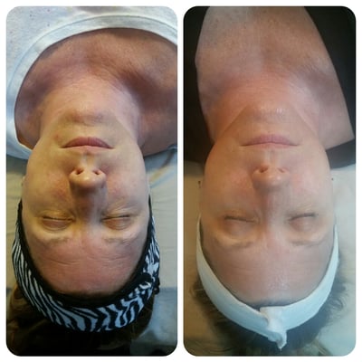 Micro Current Face Lift Therapy