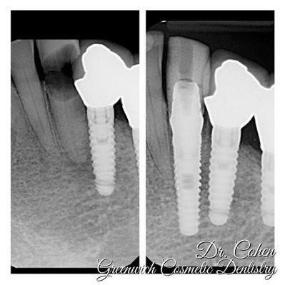 Dental Implant Case