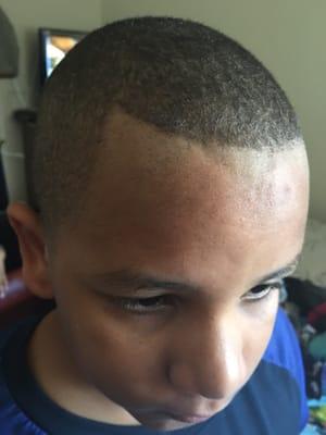 This is his Horrible hairline after getting his haircut