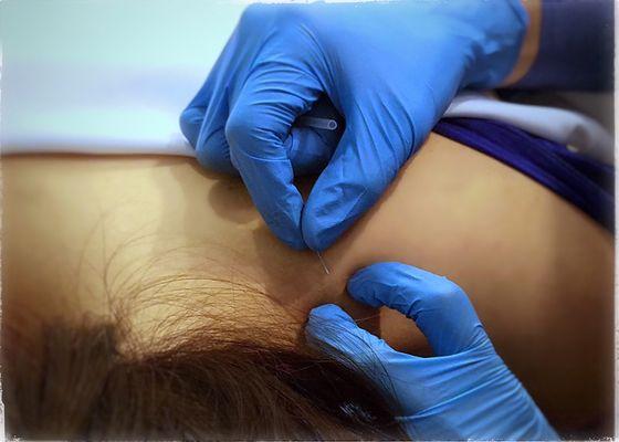 Dry needling can treat the deep muscle trigger points that cause your pain to linger even after having tried various other treatments.