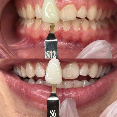 Whitening results