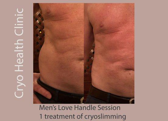 Men's love handles diminished with cryoskin. Using cold therapy to kill stubborn.