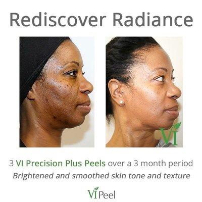 Vi Peel and Vi Derm