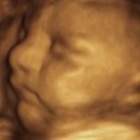 3D ultrasound at 33 weeks