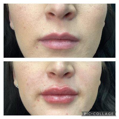 Juvederm Ultra Lips!