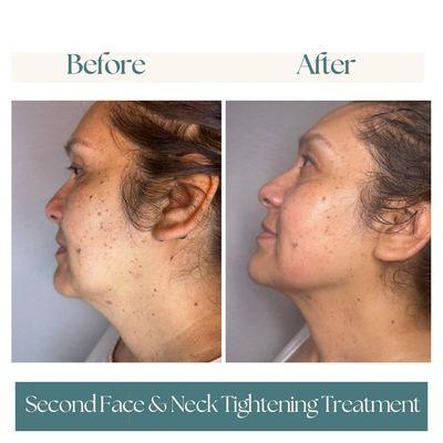 Before & After Face & Neck Tightening