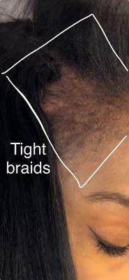 The beginning of traction alopecia. The right side of my head. The hair is pulling because of tight braids. It became a bald spot.