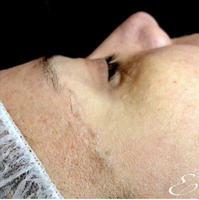 Dermaplaning