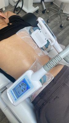 CoolSculpting of the flanks & bra rolls