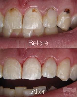 This patient had braces some years back, and we were able to improve the patient's smile with a handful of composite shades and tints.