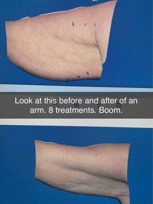 Amazing spot reduction results for this lady using Ultraslim followed with compression.