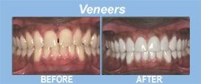 Porcelain veneers can dramatically improve the color, shape, size, spacing and positioning of your teeth...