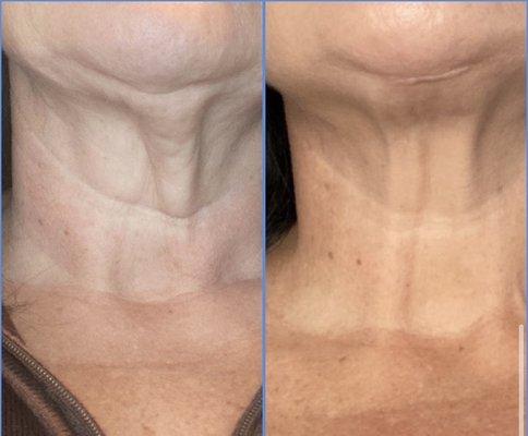 Neck lift before and after (day 13)