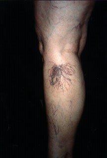 Before spider vein treatment.