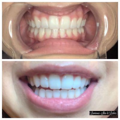 60 minutes of teeth whitening