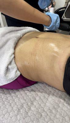 fat cavitation