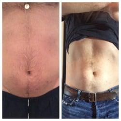 Our patient Before & After Sculpsure treatment