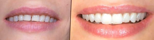 Emax Veneers to close diastema and create a beautiful smile.