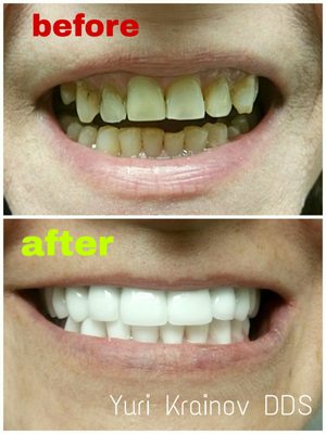 Full mouth restoration done in our office