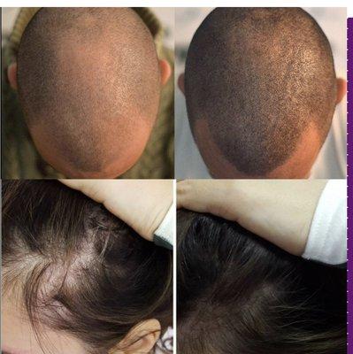 Scalp micropigmentation