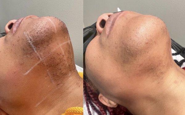 Before and after laser hair removal of the chin and under chin.